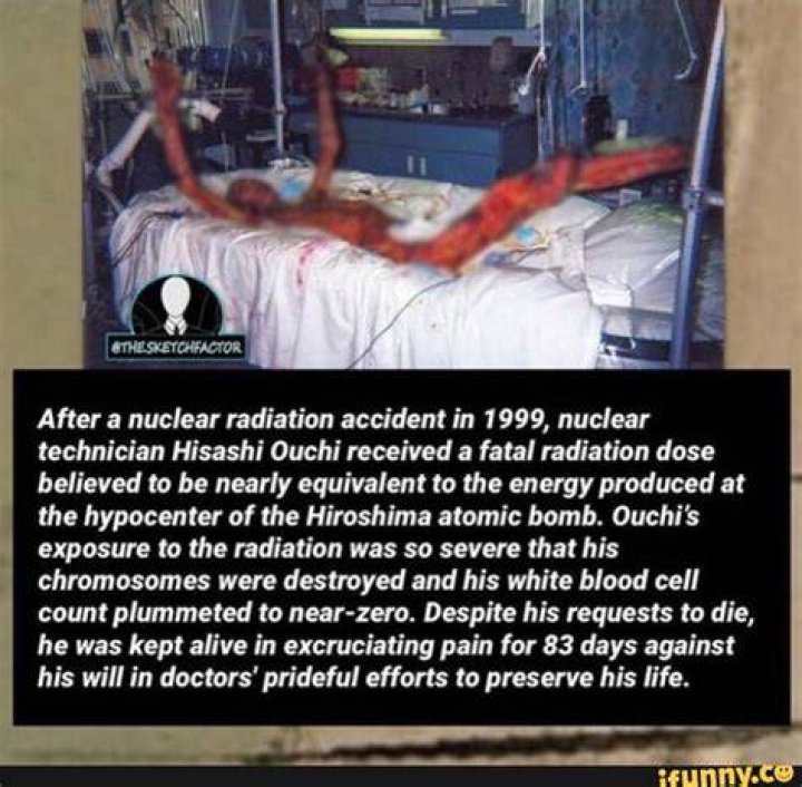 Foto Hisashi Ouchi Korban Radiasi Nuklir Terburuk dalam Sejarah, Jumlah