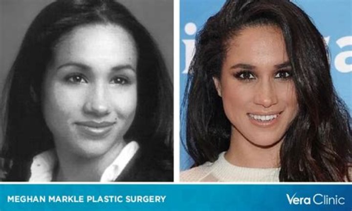 Meghan Markle Nose Job Surgery POPSUGAR Beauty