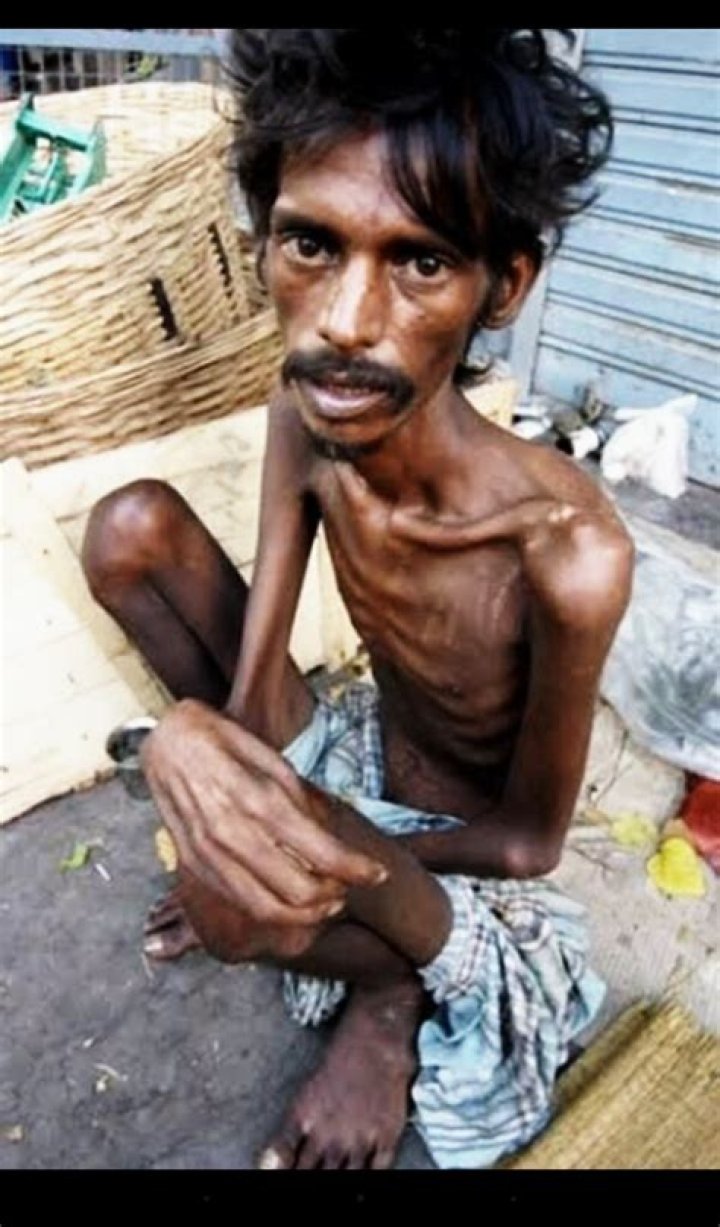 The Skinniest Person In The World: A Journey Of Resilience And Survival